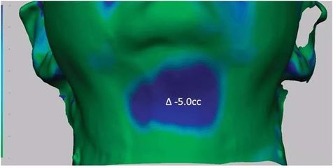 3D成像评估注射溶脂/冷冻溶脂后颏下脂肪消除情况
