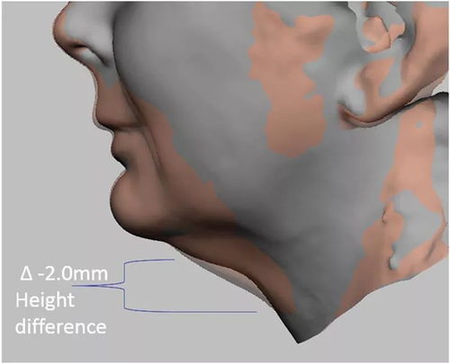 3d成像评估注射溶脂 冷冻溶脂后颏下脂肪消除情况