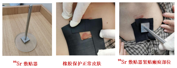 瘢痕疙瘩又丑、又痒、又痛怎么办?它的“克星”来了