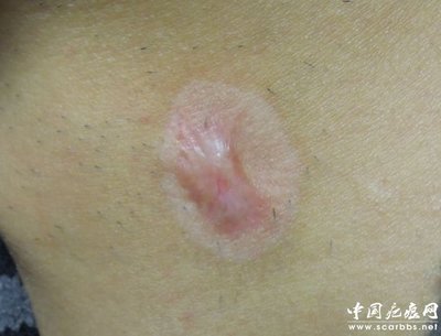 浅析放射性同位素敷贴治疗方法_仪器修复_疤痕修复_中国疤痕网 - 您身边的疤痕修复专家